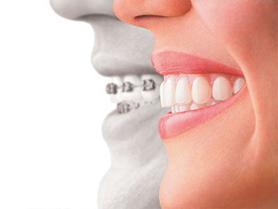 Blue Ridge Dental | Dental Cleanings, Night Guards and Dental Sealants