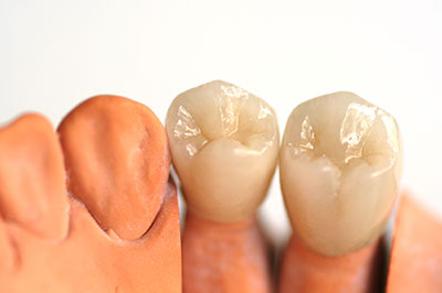 Blue Ridge Dental | Root Canals, Crowns and Night Guards