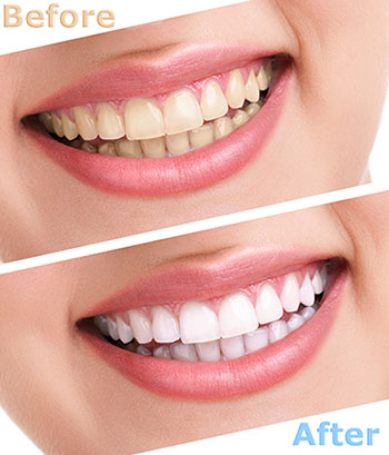 Blue Ridge Dental | Crowns, Teeth Whitening and Dental Cleanings