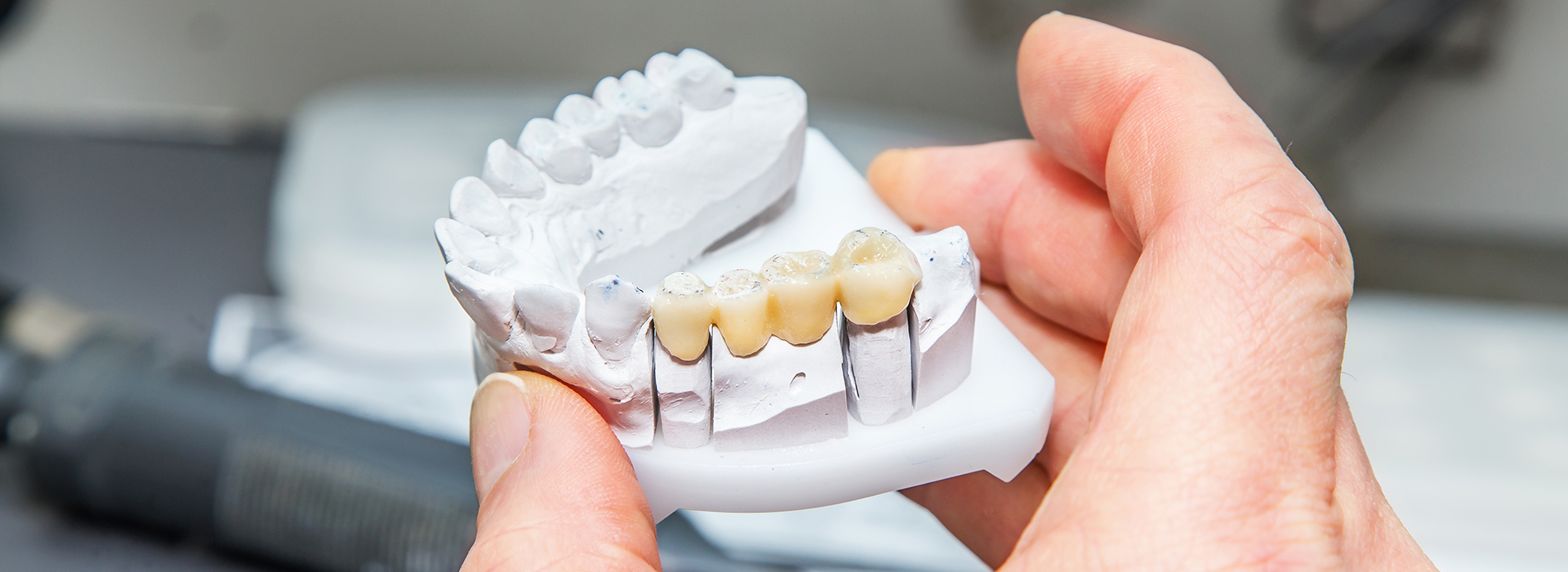 Blue Ridge Dental | Root Canals, Crowns and Fluoride Treatment