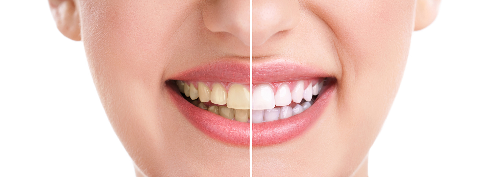 Blue Ridge Dental | Dental Sealants, Crowns and Intraoral Camera
